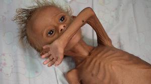 On average 130 children per day die due to starvation.